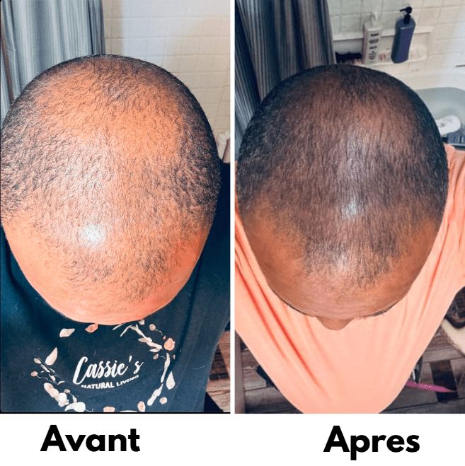Kit Alopecie