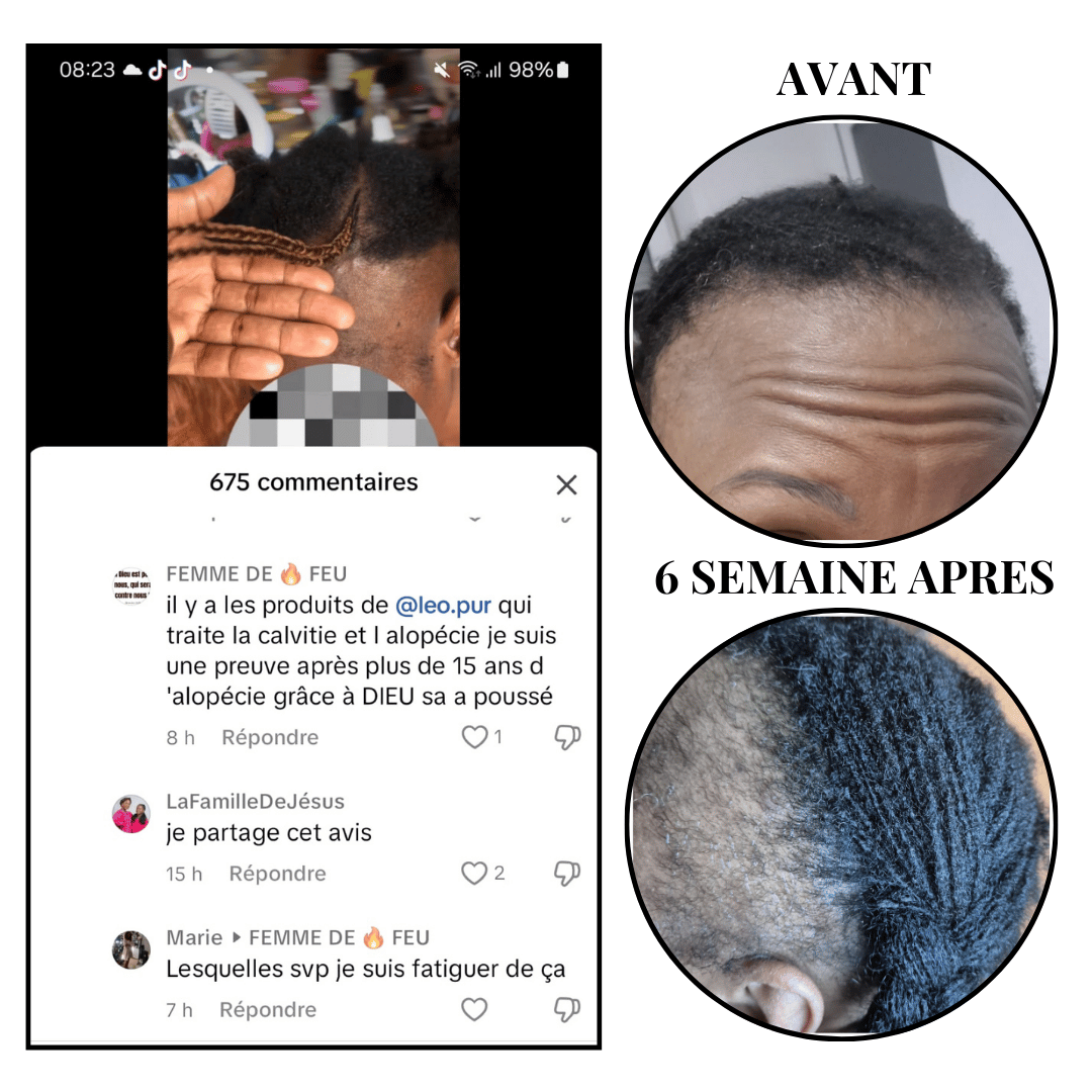Kit Alopecie