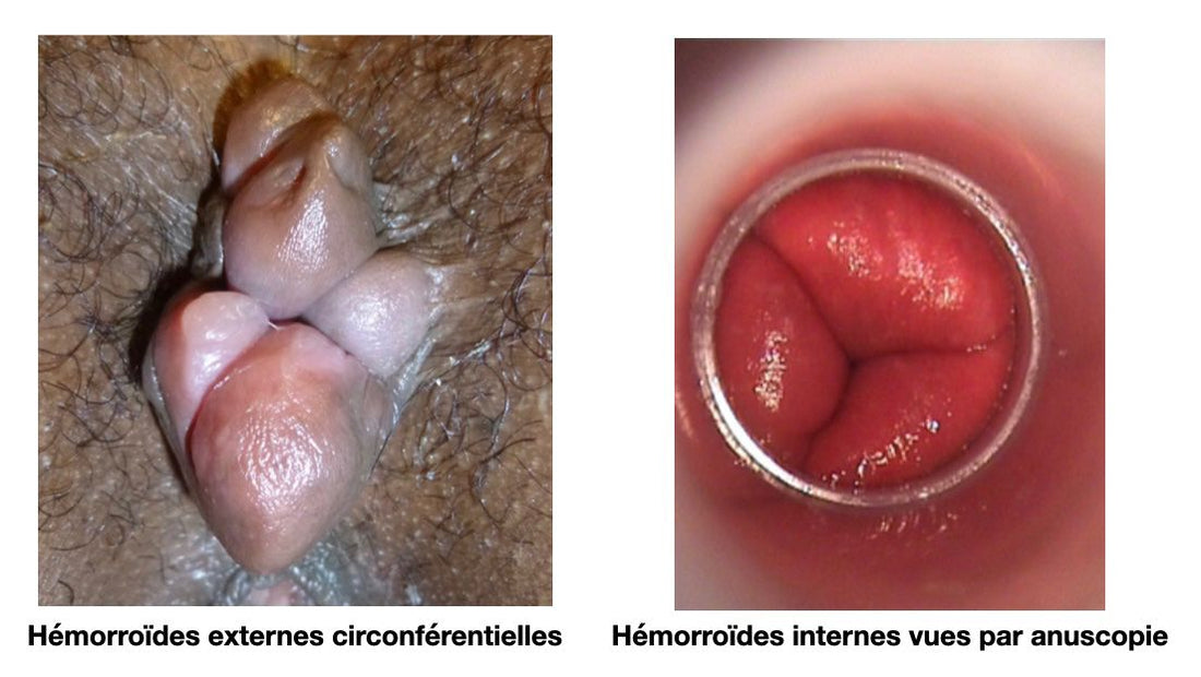 Traitements Conventionnels vs Approches Alternatives pour les Hémorroïdes