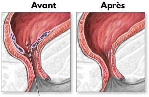 Témoignage : Comment j’ai dit Adieu aux Hémorroïdes en 3 Semaines