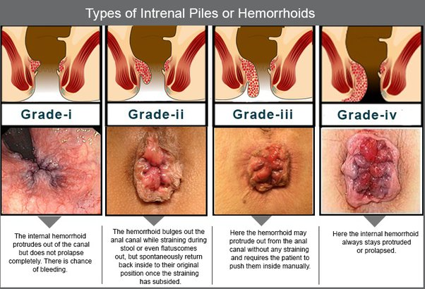 Comprendre les Hémorroïdes – Causes et Symptômes