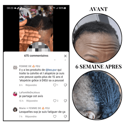 kit Anti-Alopecie